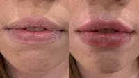 Fillers Before & After Gallery - Patient 405908 - Image 1