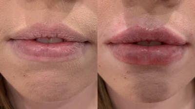 Fillers Before & After Gallery - Patient 405908 - Image 1