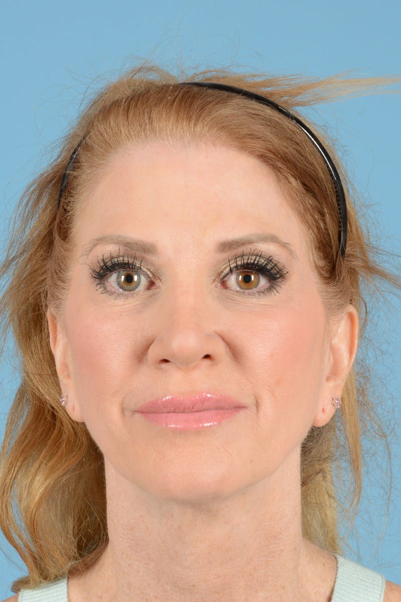 Rhinoplasty Before & After Gallery - Patient 168190 - Image 2