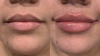 Fillers Before & After Gallery - Patient 221984 - Image 1