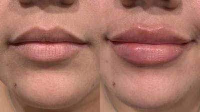 Fillers Before & After Gallery - Patient 221984 - Image 1