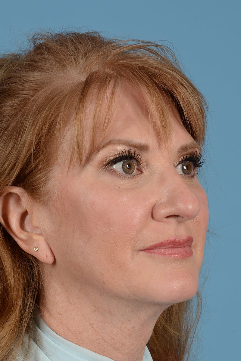 Rhinoplasty Before & After Gallery - Patient 168190 - Image 3