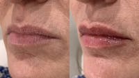 Fillers Before & After Gallery - Patient 143622 - Image 1