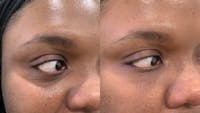Fillers Before & After Gallery - Patient 243590 - Image 1
