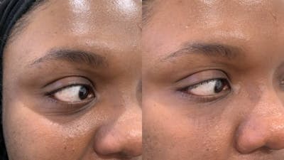 Fillers Before & After Gallery - Patient 243590 - Image 1