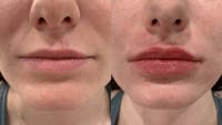 Fillers Before & After Gallery - Patient 173191 - Image 1