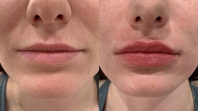 Fillers Before & After Gallery - Patient 173191 - Image 1
