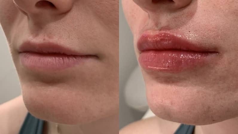 Fillers Before & After Gallery - Patient 173191 - Image 2