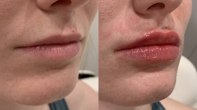 Fillers Before & After Gallery - Patient 173191 - Image 3