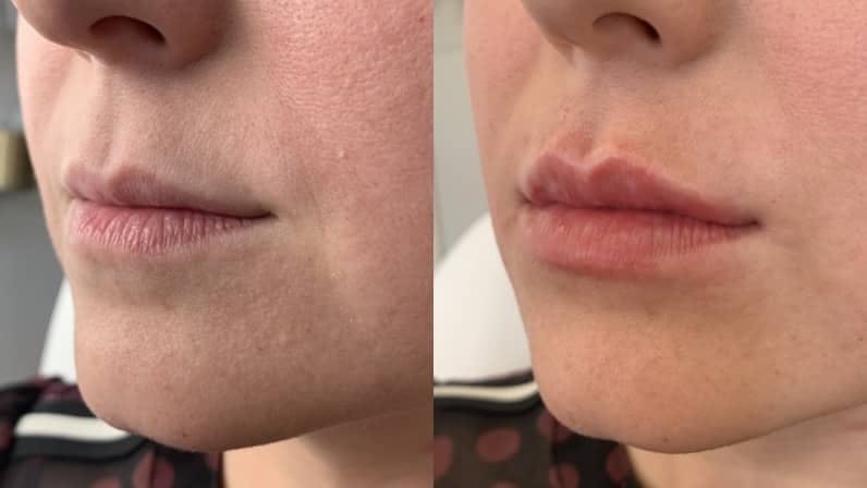 Fillers Before & After Gallery - Patient 369984 - Image 1