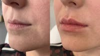 Fillers Before & After Gallery - Patient 369984 - Image 1