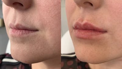 Fillers Before & After Gallery - Patient 369984 - Image 1