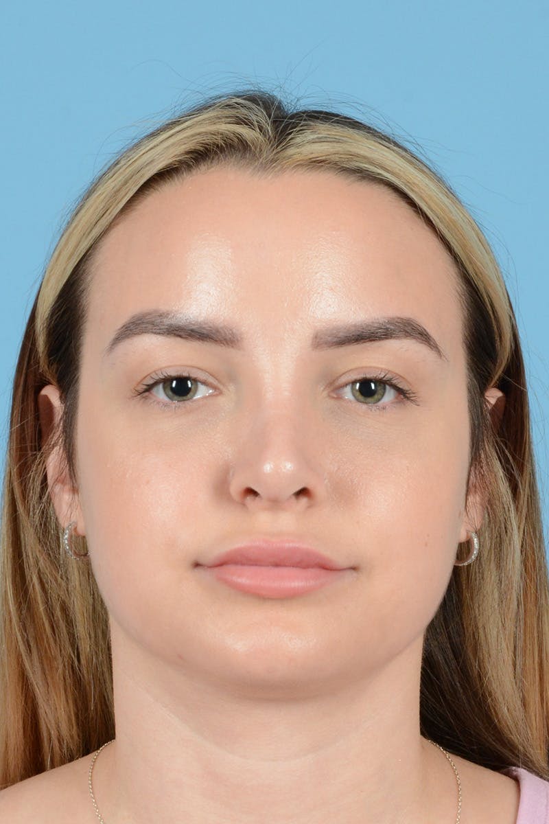 Rhinoplasty Before & After Gallery - Patient 239365 - Image 2