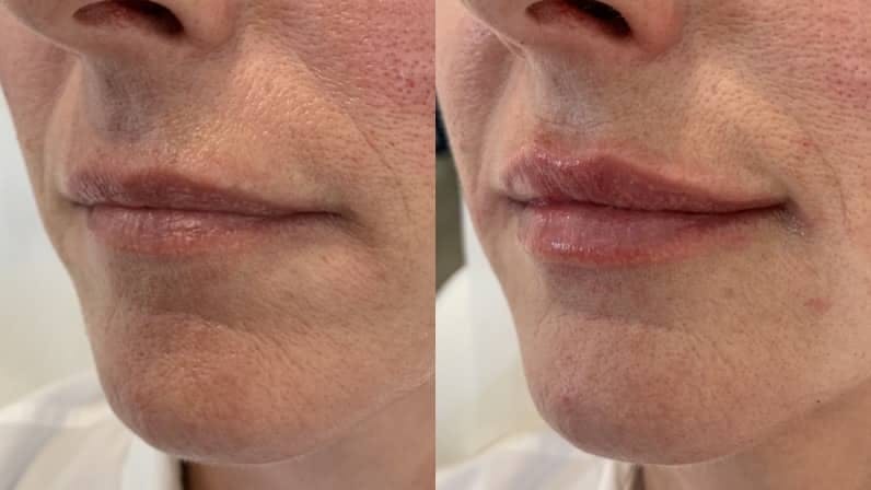 Fillers Before & After Gallery - Patient 140938 - Image 1
