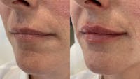 Fillers Before & After Gallery - Patient 140938 - Image 1