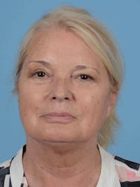 Facelift Before & After Gallery - Patient 119495 - Image 1