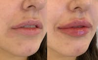 Fillers Before & After Gallery - Patient 182938 - Image 1