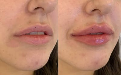 Fillers Before & After Gallery - Patient 182938 - Image 1