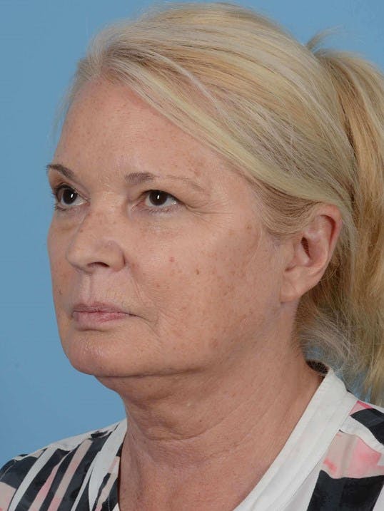 Facelift Before & After Gallery - Patient 119495 - Image 3