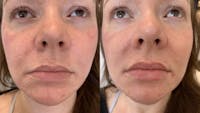 Fillers Before & After Gallery - Patient 403535 - Image 1