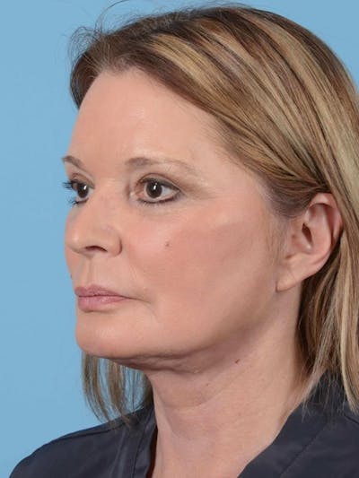 Facelift Before & After Gallery - Patient 119495 - Image 4