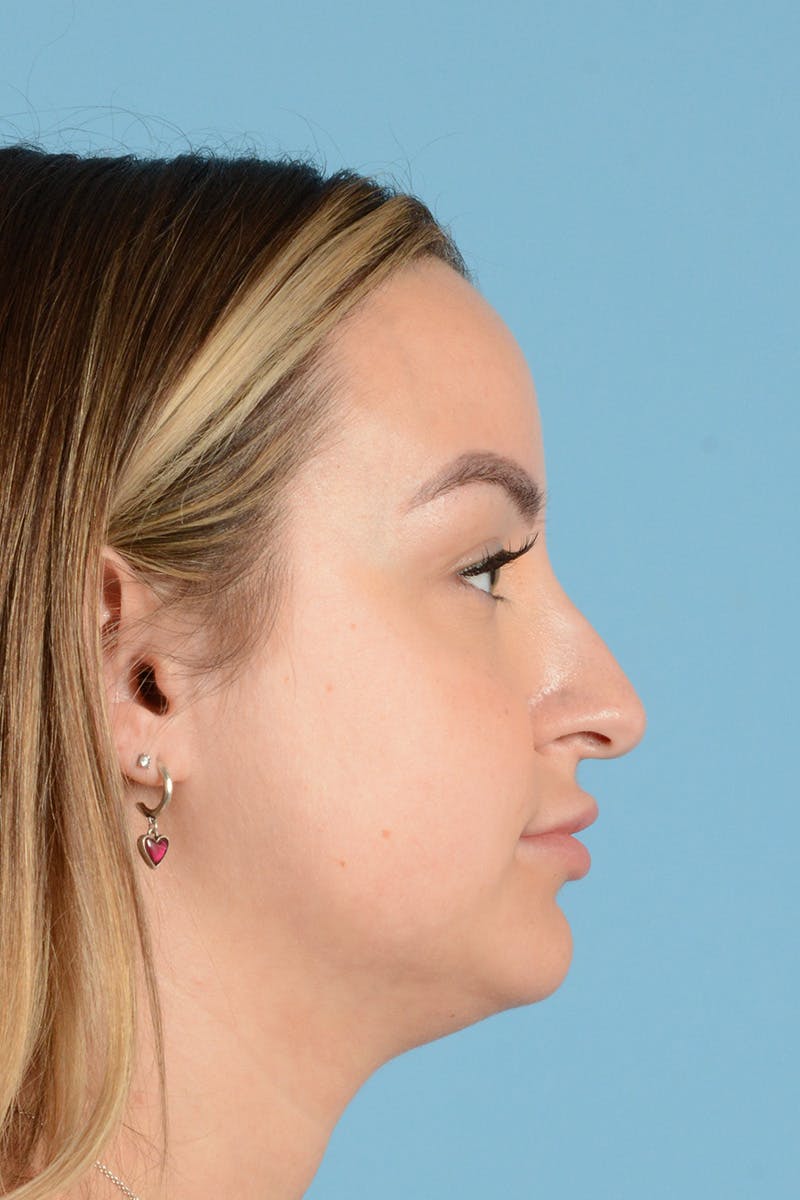 Rhinoplasty Before & After Gallery - Patient 239365 - Image 5