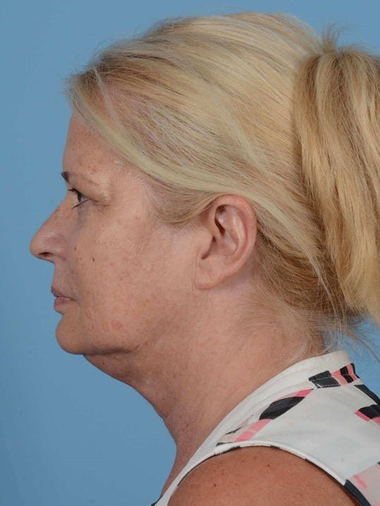Facelift Before & After Gallery - Patient 119495 - Image 5