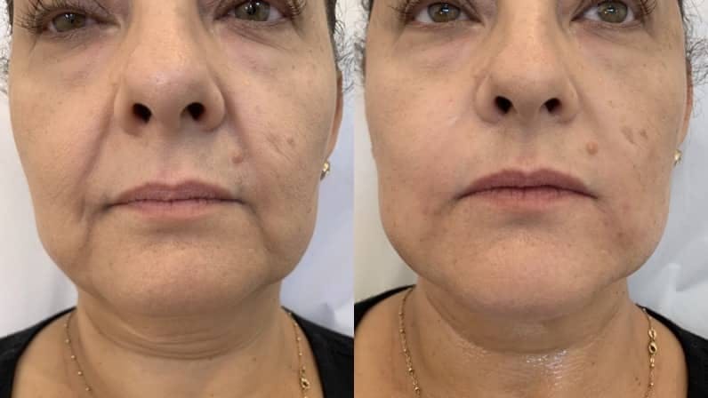 Fillers Before & After Gallery - Patient 172080 - Image 1