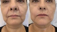 Fillers Before & After Gallery - Patient 172080 - Image 1