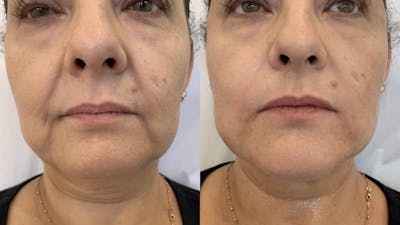 Fillers Before & After Gallery - Patient 172080 - Image 1