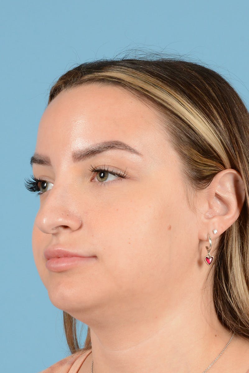 Rhinoplasty Before & After Gallery - Patient 239365 - Image 7