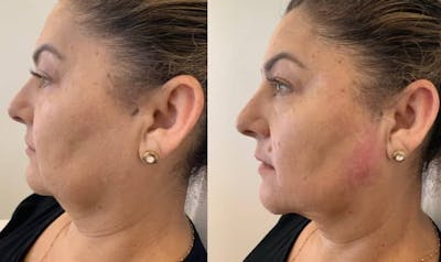 Fillers Before & After Gallery - Patient 172080 - Image 2