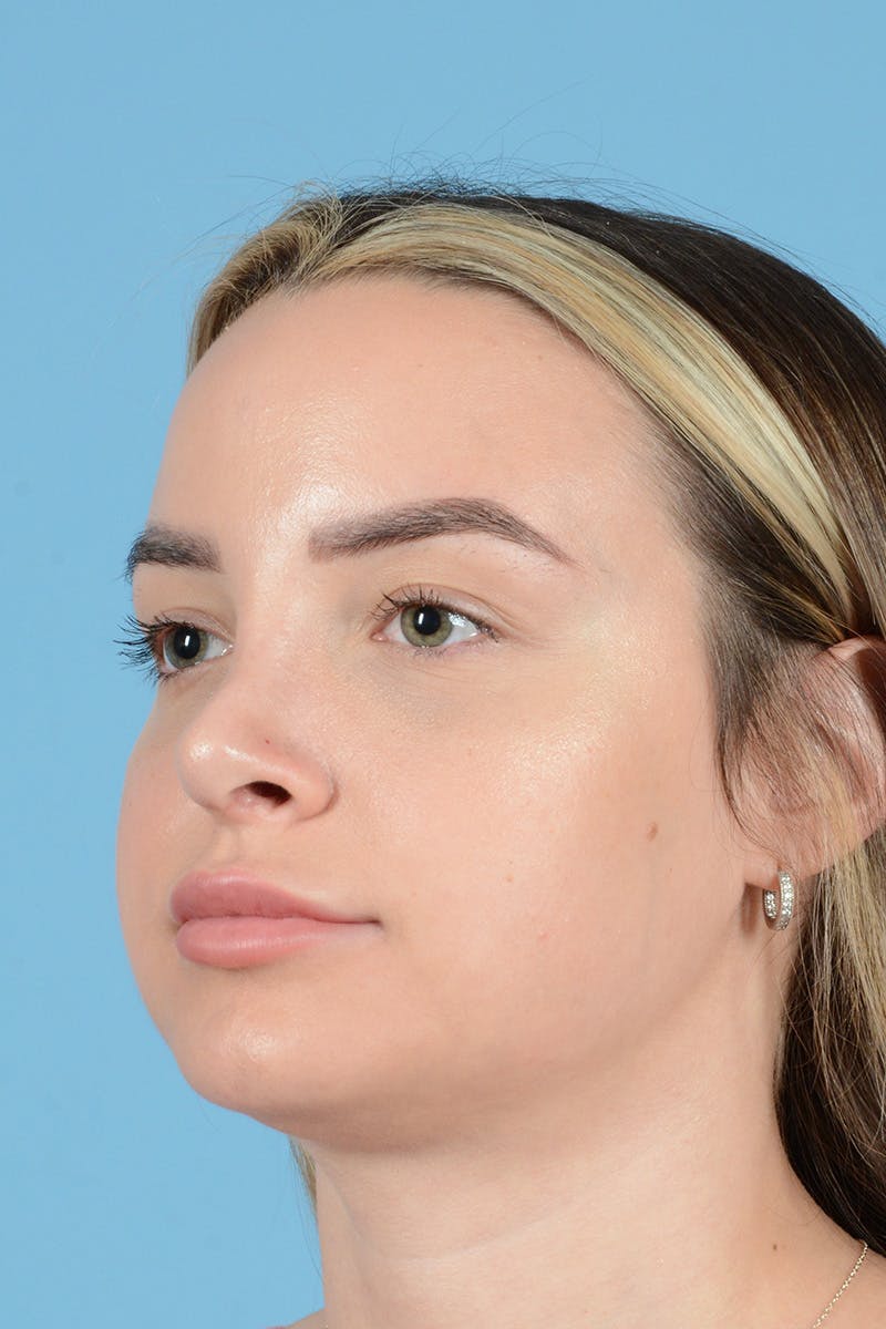 Rhinoplasty Before & After Gallery - Patient 239365 - Image 8
