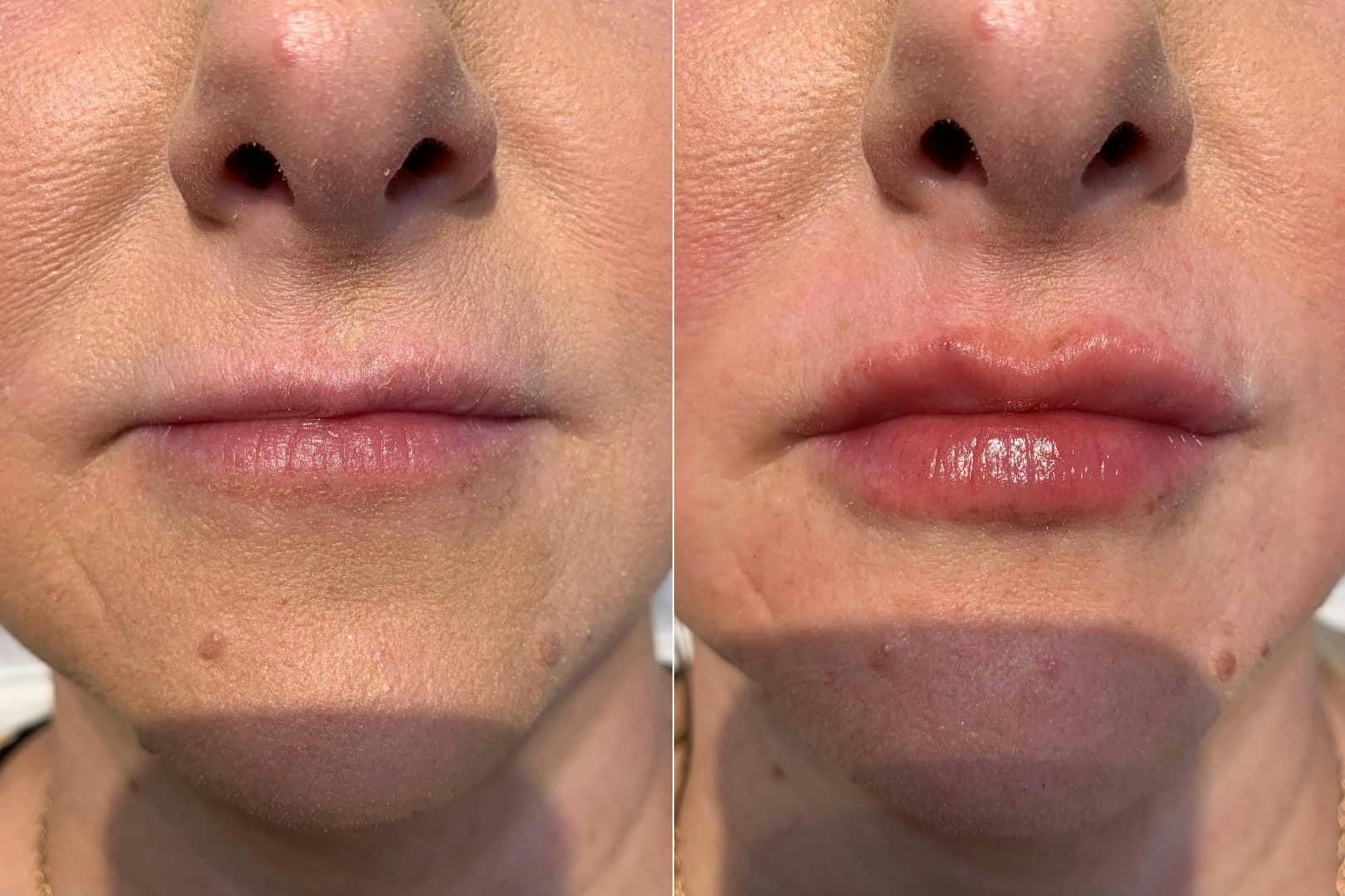 Fillers Before & After Gallery - Patient 184015 - Image 1