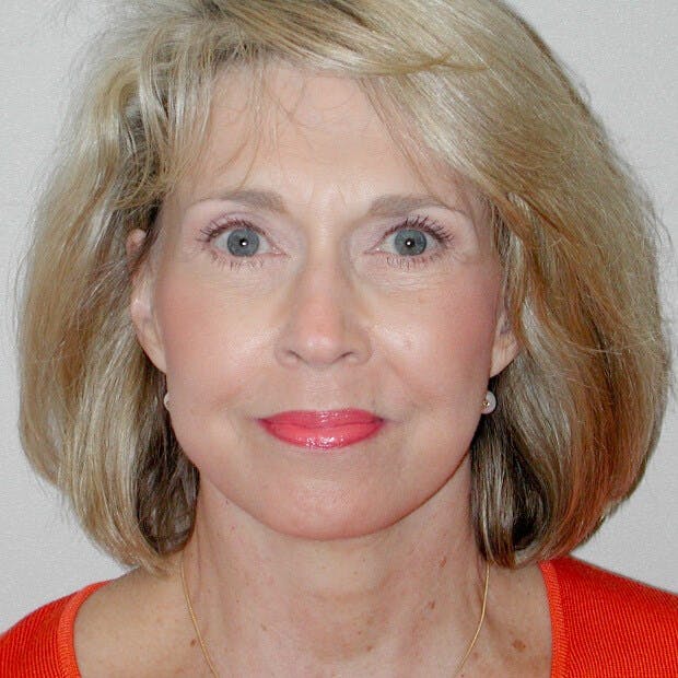 Facelift Before & After Gallery - Patient 359740 - Image 2