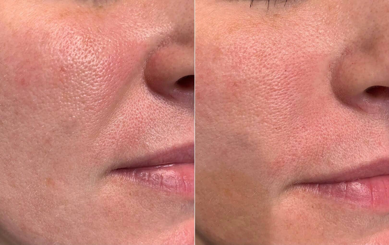 Fillers Before & After Gallery - Patient 251197 - Image 1