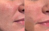 Fillers Before & After Gallery - Patient 251197 - Image 1