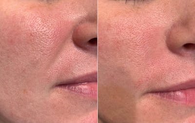Fillers Before & After Gallery - Patient 251197 - Image 1