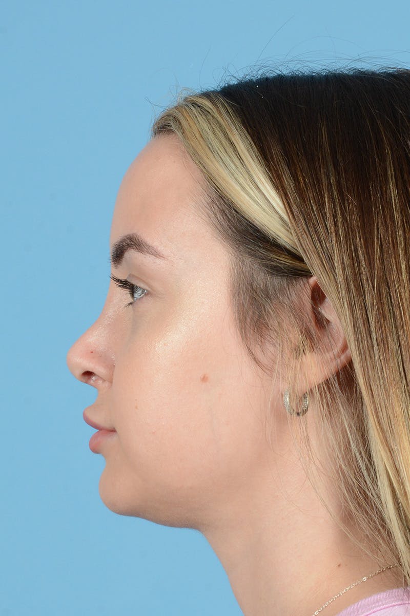 Rhinoplasty Before & After Gallery - Patient 239365 - Image 10