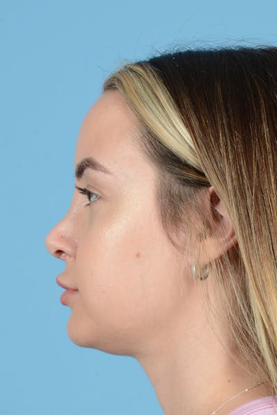 Rhinoplasty Before & After Gallery - Patient 239365 - Image 10