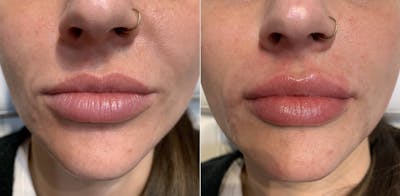 Fillers Before & After Gallery - Patient 465296 - Image 1