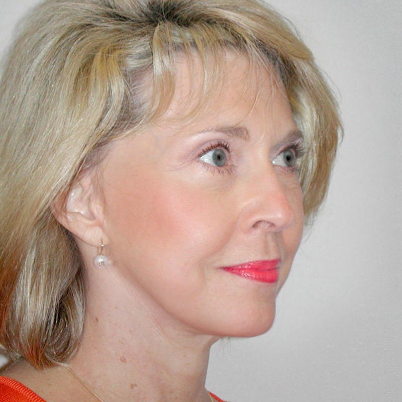 Facelift Before & After Gallery - Patient 359740 - Image 4