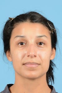 Rhinoplasty Before & After Gallery - Patient 177071 - Image 1