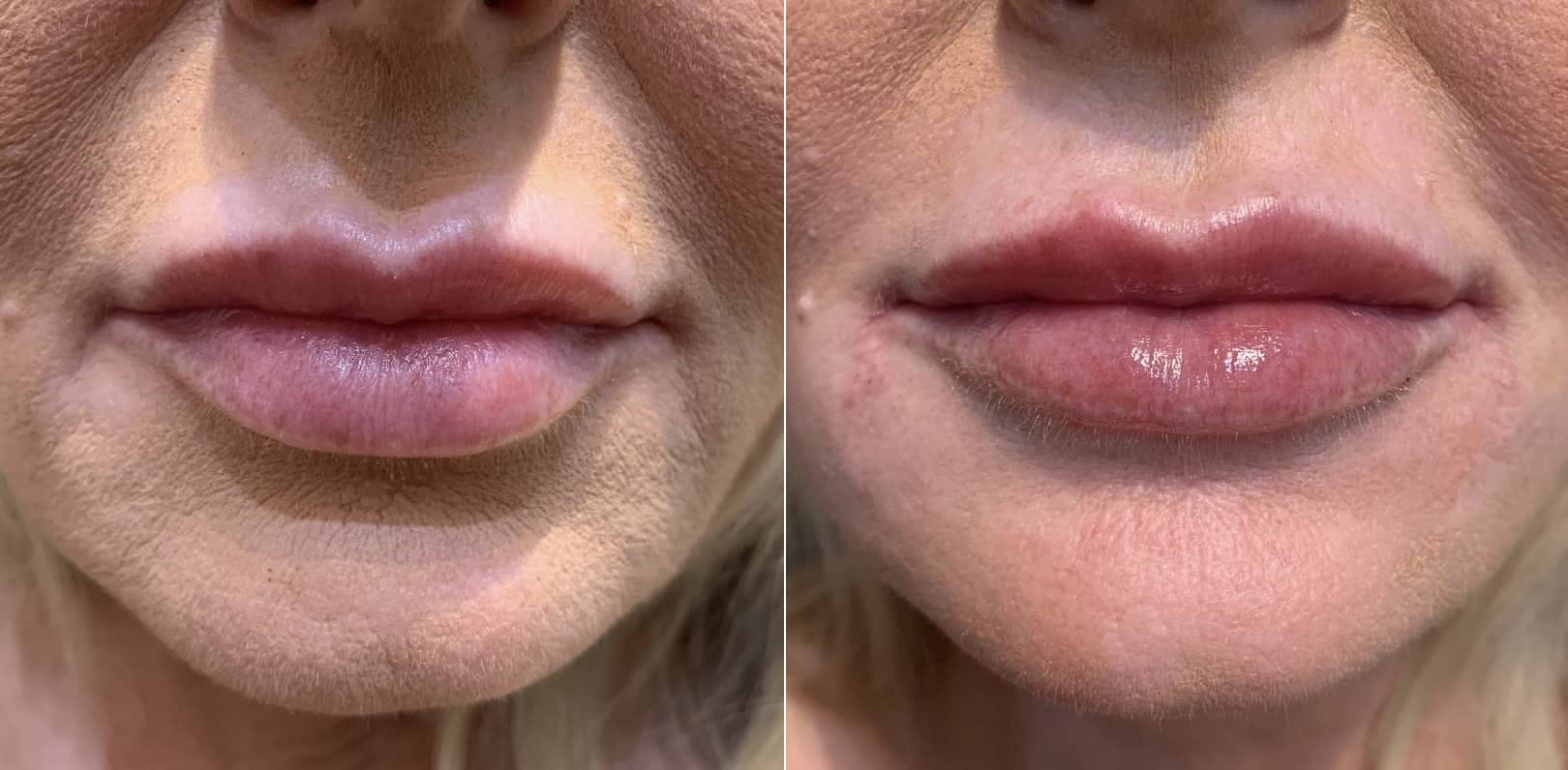 Fillers Before & After Gallery - Patient 365675 - Image 1