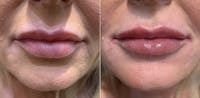 Fillers Before & After Gallery - Patient 365675 - Image 1