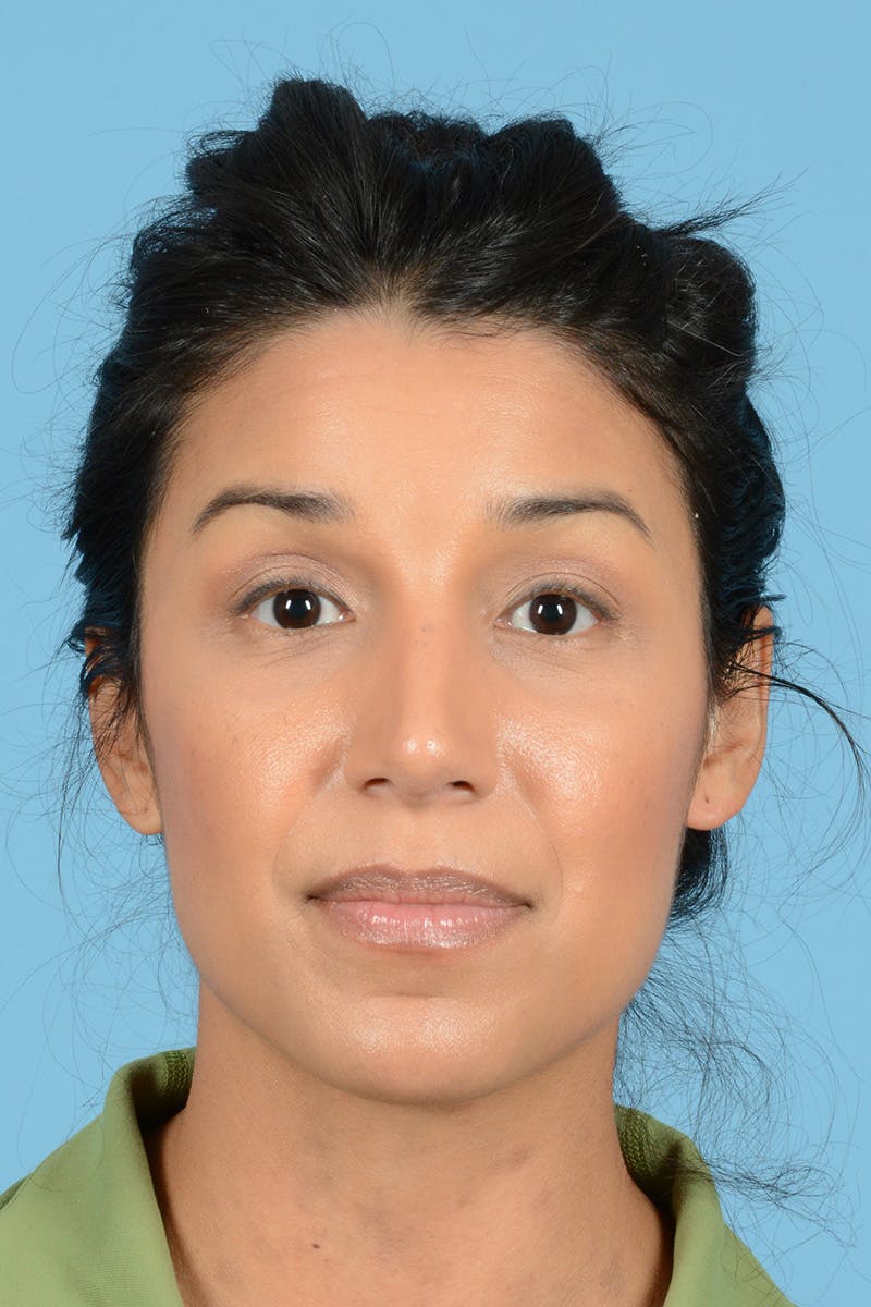 Rhinoplasty Before & After Gallery - Patient 177071 - Image 2