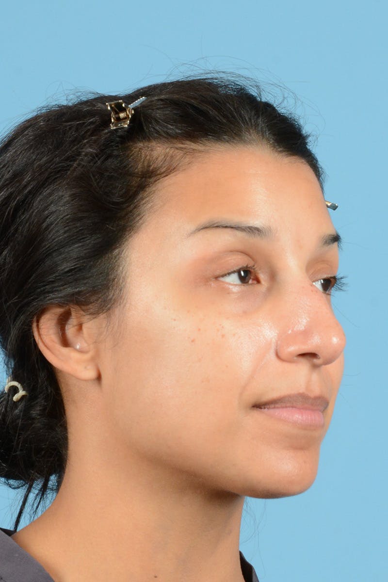 Rhinoplasty Before & After Gallery - Patient 177071 - Image 3