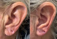 Fillers Before & After Gallery - Patient 111460 - Image 1