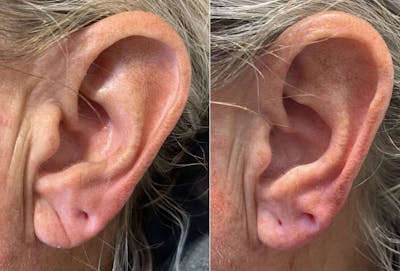 Fillers Before & After Gallery - Patient 111460 - Image 1