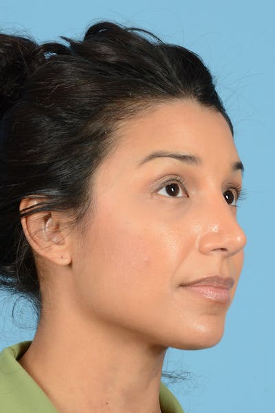 Rhinoplasty Before & After Gallery - Patient 177071 - Image 4